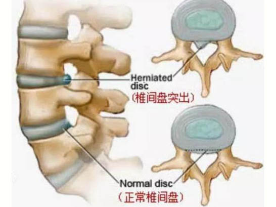 无菌性炎症致痛学说与颈肩腰腿痛的发病机制