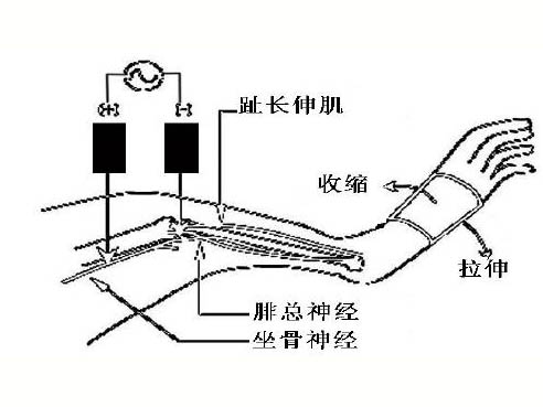 肌肉延迟性酸痛的机制研究进展